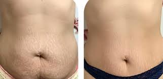 These best stretch mark tattoos remind you to embrace your body as the work of art it is! Stretch Mark Tattoo Skin Camouflage What S The Fuss About Ink Illusions