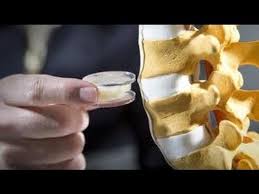 Fizioterapia este o metoda extrem de folosita, dar si. Ce Este Inlocuirea Discului Herniat Hernia De Disc Operata Youtube