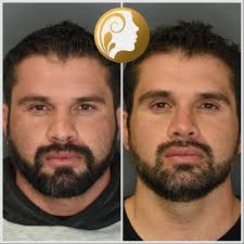 Resultado a 4 meses de Rinoplastia Primaria. Abordaje endonasal y  preservación, este paciente tenia un problema funcional y ademas quería  mejorar el aspecto de su nariz por lo que se corrigieron los