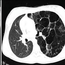 C'est un organisme de service public rattaché à la sécurité sociale pour la france compte 101 bureaux cpam, soit au moins un par département. Type I Congenital Cystic Adenomatoid Malformation Cpam In A Download Scientific Diagram