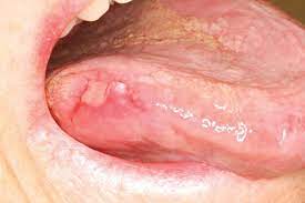 There are many types of skin cancer, each of which can look different on the skin. Early Detection Of Mouth Cancer Improving Success Dentistry Co Uk