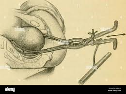 Image result for Manual Rotation in Occipitoposterior Presentation
