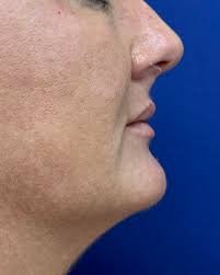 Before and After Breast Augmentation 🚺👍🤩 For more information regarding  the procedure and booking, please...