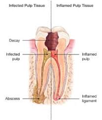 You may receive a temporary crown or a filling after the root canal while a more permanent restoration is made. Root Canal Newport Beach Ca Root Canal Therapy