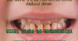 Tooth Decay It S Preventable Oralcare Teeth Decay Dentistry Family Koolsmiles Dental Hygiene School Dental Fun Baby Dental Care
