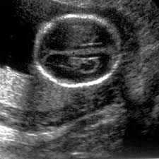 Ultrasound Markers Babycenter Canada