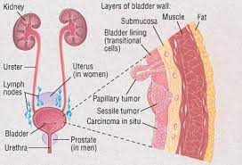 Women could confuse some colorectal cancer symptoms with premenstrual syndrome (pms) or their periods. Bladder Cancer Guide Causes Symptoms And Treatment Options