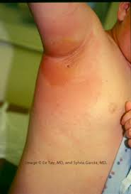 Image result for erysipel photos)