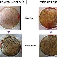 It comes with 5 speed controls which are adjustable from 8,000 rpm to 18,000 rpm oscillations and has an upgraded metal motor to efficiently. Earlier And Faster Hair Re Growth At 1 Week Noted In Microneedling Download Scientific Diagram