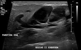 Ultrasound allows us to look at the kidneys, to help. Jugulodigastric Lymph Node Normal Ultrasound Radiology Case Radiopaedia Org