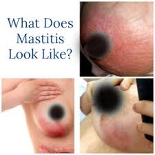 With more mild cases (meaning that symptoms are similar to the common cold or flu), people tend to get better on their own in 10 to 14 days, dr. How Long Does A Mastitis Fever Last