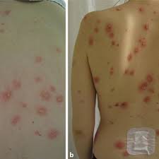 Check spelling or type a new query. Pdf Systemischer Lupus Erythematodes Ungewohnliche Hautmanifestationen