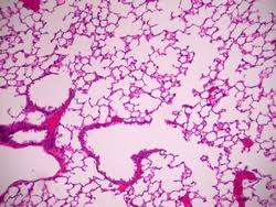 Image result for Pneumonia