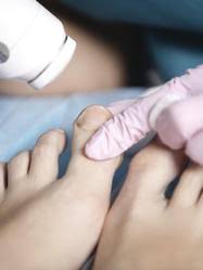 Des taches blanches apparaissent parfois sur l'ongle et ce phénomène est connu sous le nom de leuconychie. Melanome De L Ongle Depister Et Soigner Le Melanome De L Ongle