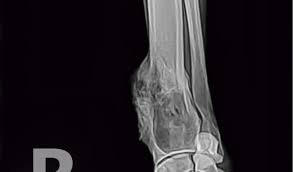Hey my dog have also that i was out of my home for 3 mounts i when i come back i notes i don't know what to do. Osteosarcoma In Dogs Petcoach