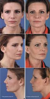 2024 미국에서 안면거상 잘하는 성형외과 의사 TOP 4