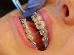 Dental braces that incorporate brackets, elastics, and wires successfully treat most overbites. Clear Colorful Metal Braces In Johns Creek Ga Ricci Orthodontics