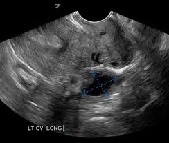 It then converts this data into a visual representation of how fast and in what direction blood is flowing. Gynecology Pelvic Ultrasound Made Easy Step By Step Guide Pocus 101