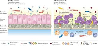 Discomfort in the pelvic area. The Microbiome In Prostate Inflammation And Prostate Cancer Prostate Cancer And Prostatic Diseases
