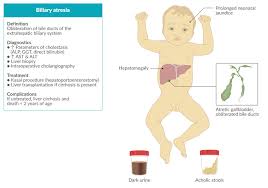 Image result for acholic stools human