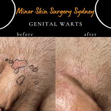 Image result for genital warts
