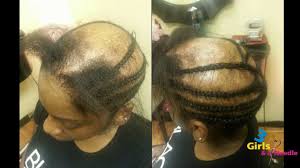 Alopecia Sew In Done By 3 Girls And A Needle Video Https Blackhairinformation Com Video Gallery Alopeci In 2020 Alopecia Hairstyles Alopecia Grow Black Hair Long
