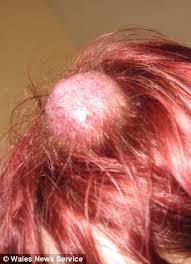 Image result for lump