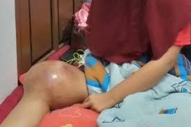 Maybe you would like to learn more about one of these? Awalnya Jatuh Atlet Voli Ini Tak Sadar Idap Tumor Ganas Di Lutut Kanan Hingga Harus Diamputasi Semua Halaman Grid Health