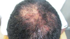 Image result for dry scabs on the head in children