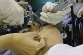 Image result for Intubation Associated Sinusitis
