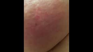 The symptom is medically known as erythema. No Lump No Tumor The Breast Cancer Disguised As A Skin Rash Wfaa Com