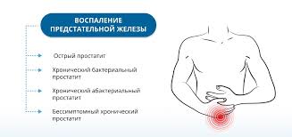 Prostatit U Muzhchin Priznaki Simptomy I Prichiny Vozniknoveniya Zabolevaniya Prostaty