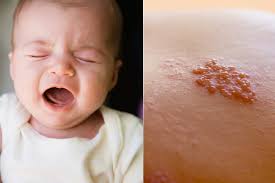 Image result for shingles in children