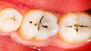 It takes tom 20 minutes to get to work in the morning. Dentist Discusses The 5 Stages Of Cavity Formation Ponte Vedra Complete Dentistry