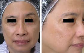 Treatment of refractory melasma with the MedLite C6 Q-switched Nd:YAG laser  and alpha arbutin: A prospective study