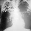 The ap lordotic projection is often used to evaluate suspicious areas within the lung apices that appeared obscured by overlying soft tissue, upper ribs or the clavicles on previous chest views (e.g. 1