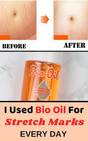 Bio Oil White Stretch Marks Before And After I Used Bio Oil For Stretch Marks Every Day Here Is What You Should Know Oil For Stretch Marks Bio Oil Stretch Marks