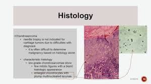 Image result for Chondrosarcoma