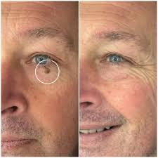 This Lovely Client Was Over the Moon with His Cryopen Results! 😃 Gary came  to me with a skin lesion near his eye, he initially went to a clinic who  advised that
