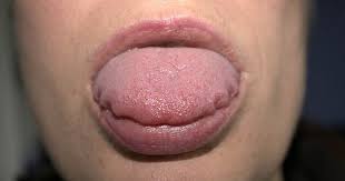 Hereditary angioedema attacks-Angioedema | Homeopathic | Best Homeopathic Doctor in Pakistan | Dr. Qaisar Ahmed MD, DHMS