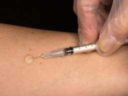 Tuberculosis testing is very mportant. Tuberculosis Skin Test What To Expect Diagnosis And Symptoms