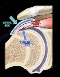 Internal Impingement Of The Shoulder Huffpost