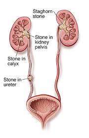 Understanding Kidney Stones