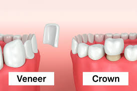 Veneers Vs Crowns: Which One Is The Best? Differences, Pros And Cons