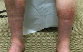 It is chronic and hence is hardly reversible. Why Do I Have Brown Spots On My Legs Vein Specialists Of Carolinas