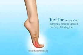 Turf toe injuries result in pain at the base of the great toe. Turf Toe Symptoms Causes And Treatments The Coldest Water