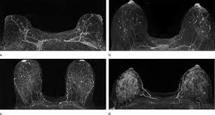 When cancer is suspected, imaging techniques reveal accurate details of tumours, increasing the chances of successful treatment; Mri Shows Potential To Improve Breast Cancer Risk Prediction