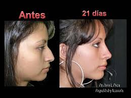 If This Is Same Person Nose Job Chin Implant Or Jaw Repositioning Cirugia Plastica Estetica Y Reconstructiva Mexico Nose Job Plastic Surgery Nose Surgery