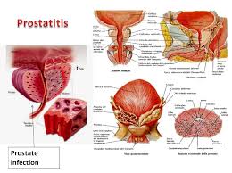Image result for Acute Bacterial Prostatitis