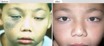 Laser Removal Of Nevus Of Ota Dermatologist Malaysia